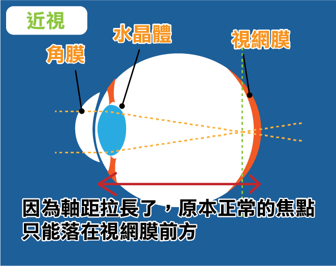 為什麼會近視,軸距是什麼?為什麼要戴控制鏡片?戴了可以回復視力嗎? - 製圖玩家